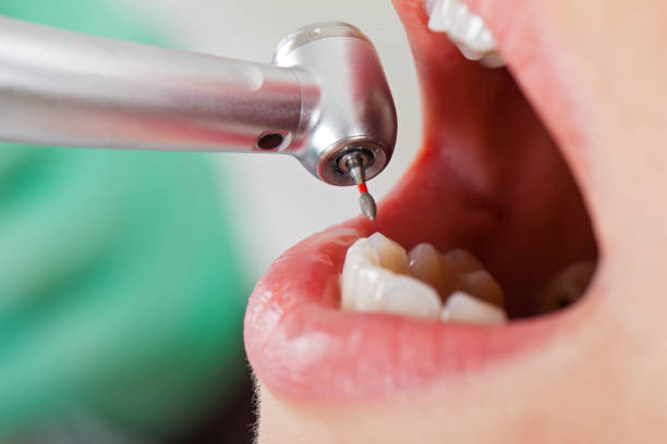 Best Emergency Wisdom Tooth Extraction in Ashland, CA